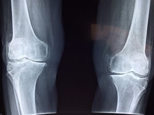 Osteoporoza – jak chronić się przed jej skutkami?